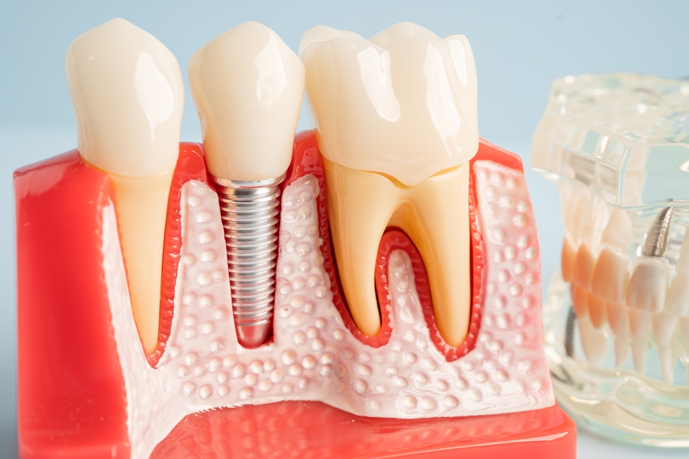 Dental Implants at Key Dental