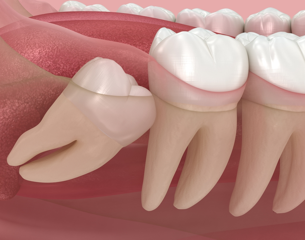 Wisdom Teeth Removal at Key Dental